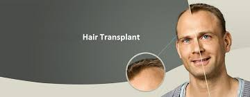 Illustration for article titled 5 Advantages of Hair Transplant Surgery